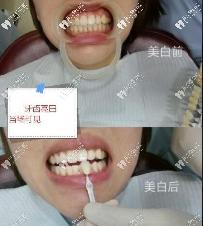 皓齒美白前后對比 西安畫美團(tuán)圓口腔門診部