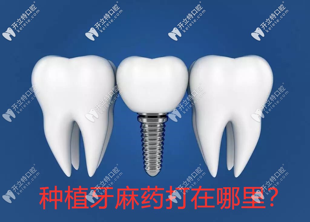 弱弱的問一句:種植牙麻藥打在哪里,多久失效