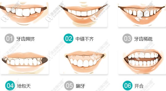 在溫州藝星口腔簡單矯正病例6980元起