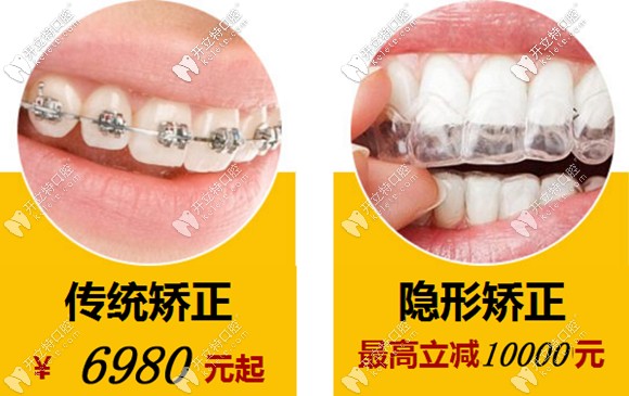 不得不說溫州牙齒矯正6千多元的價格還是比較劃算滴