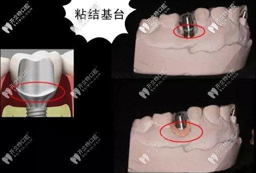 粘結基臺的臨床應用