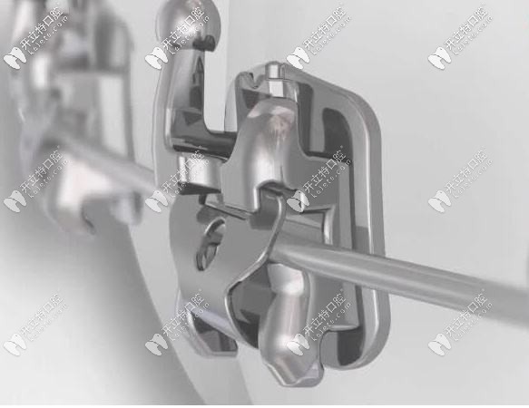 自鎖托槽矯正的外觀