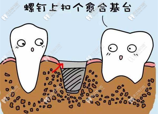 如何選擇合適的愈合基臺(tái)