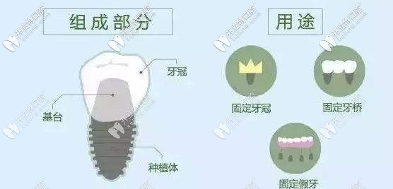 種植體的三個(gè)步驟及用途