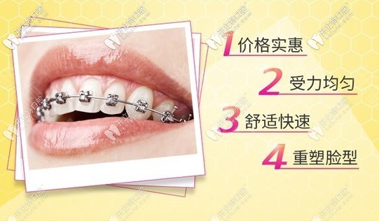 屬于你的金屬牙齒矯正優(yōu)惠活動(dòng)