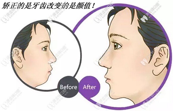 數(shù)字化矯正還兼顧了顏面美學(xué)設(shè)計(jì)