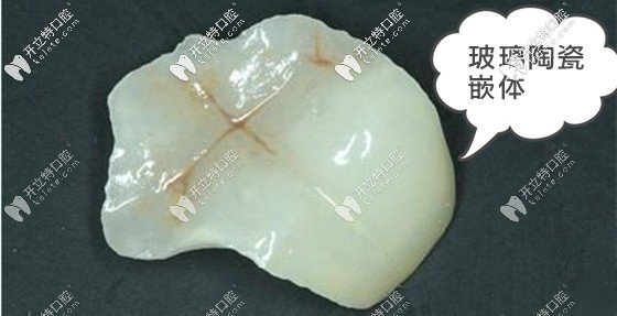 從玻璃陶瓷嵌體的優(yōu)缺點(diǎn)和價格來分析這個牙嵌體怎么樣?