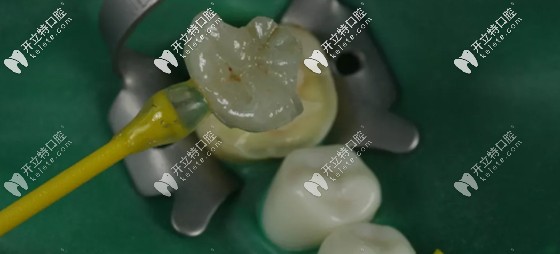 玻璃陶瓷嵌體使用年限較長(zhǎng)