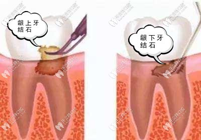 洗牙竟然還要把牙齦翻開洗?這是神馬操作!