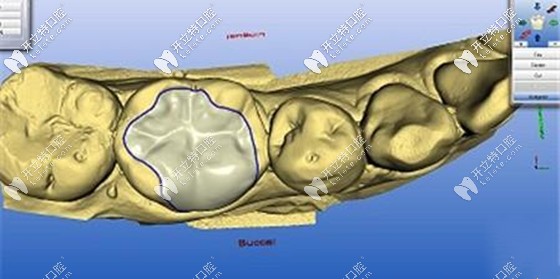 玻璃陶瓷嵌體的缺點(diǎn)是對(duì)于真牙缺損大的牙不適合