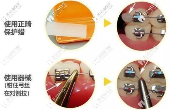 對于正畸鋼絲滑出的處理方法