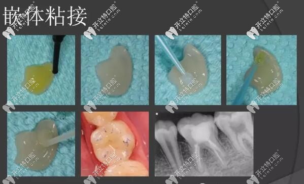 嵌體補(bǔ)牙過(guò)程