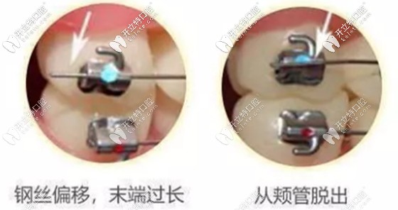 鋼絲滑出示意圖