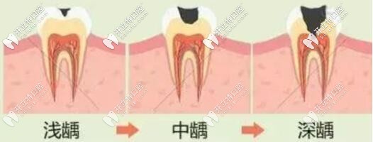 牙齒的齲壞程度選擇嵌體材料
