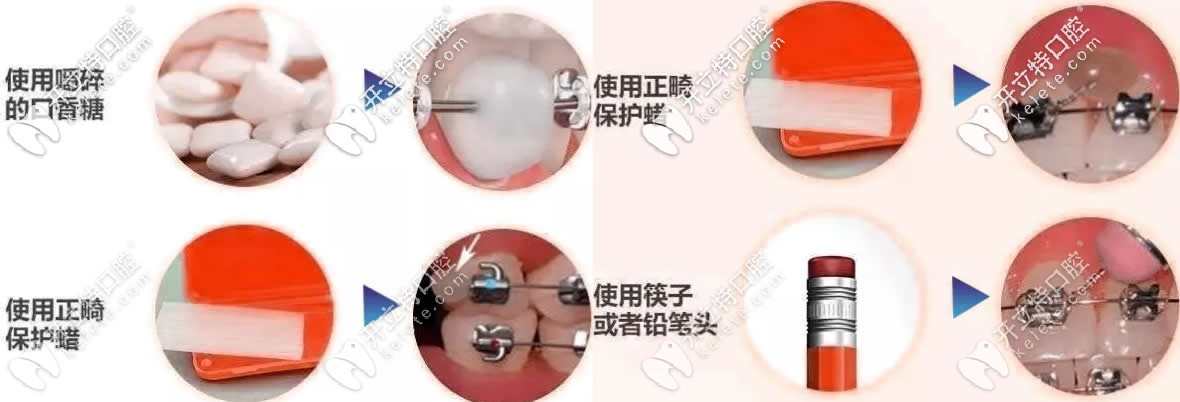 戴金屬托槽牙套結(jié)扎絲脫出的解決方法