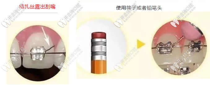 金屬牙套的鋼絲扎嘴怎么辦