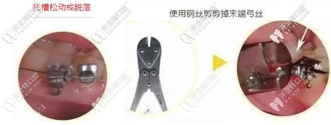 牙齒矯正中托槽松動脫落怎么辦