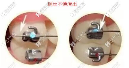 牙齒矯正期間金屬牙套鋼絲不慎滑出