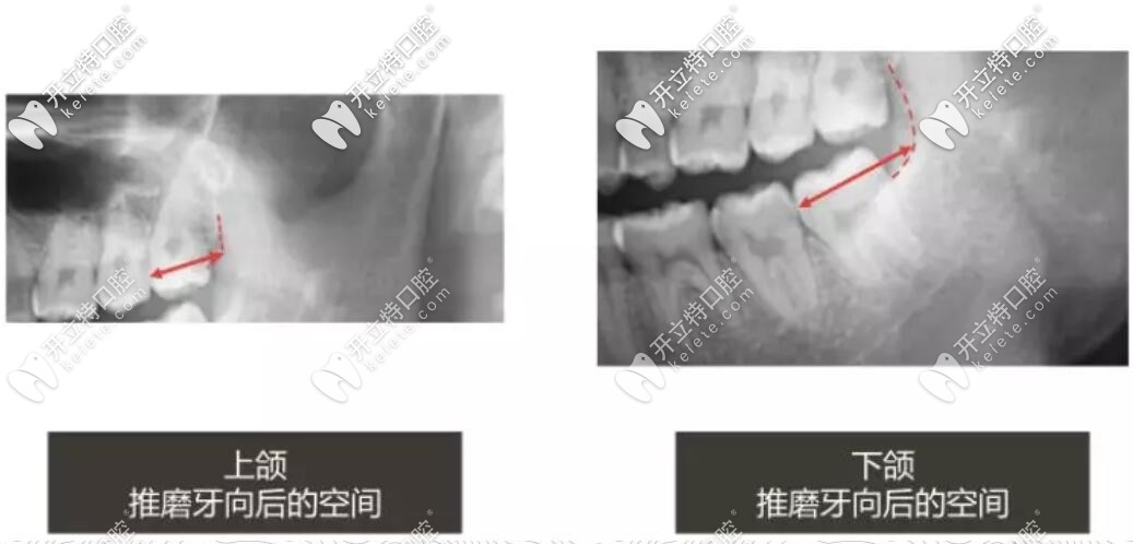 隱適美推磨牙向后的界限