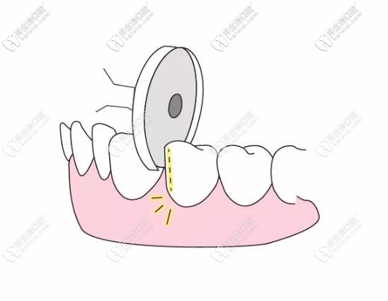 漲姿勢：片切和拔牙的利弊你真的清楚嗎？