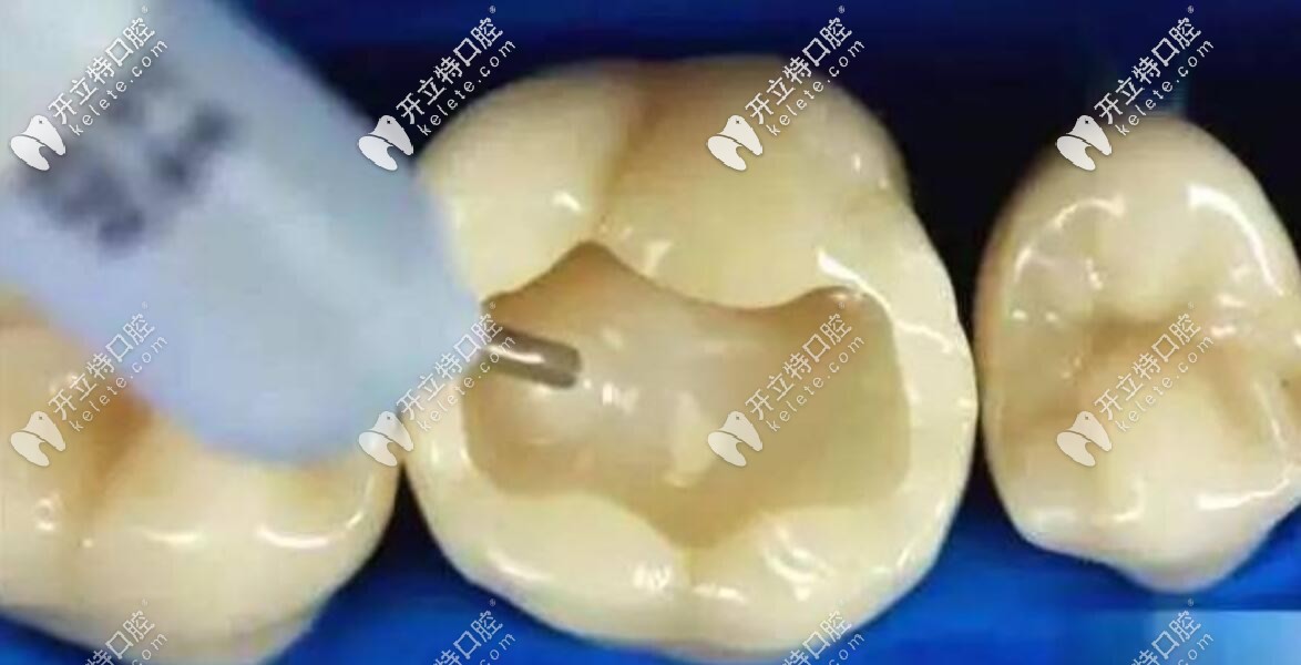 樹脂嵌體和瓷嵌體價格相差那么大，到底有啥區(qū)別？