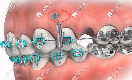 正畸種植釘?shù)淖⒁馐马? border=