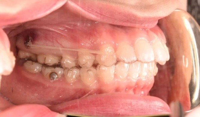 妹紙做隱適美磨牙后推打骨釘?shù)恼澜?jīng)歷,沒(méi)想到效果挺不錯(cuò)