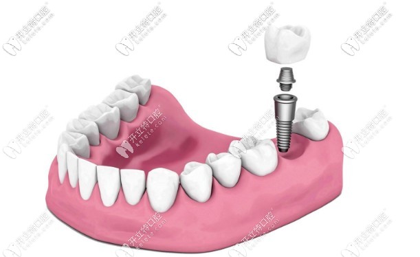 種植牙一期手術(shù)完成