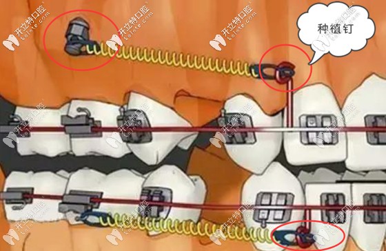 你們都在意正畸種植釘?shù)淖饔?而我更關(guān)心打骨釘什么感覺