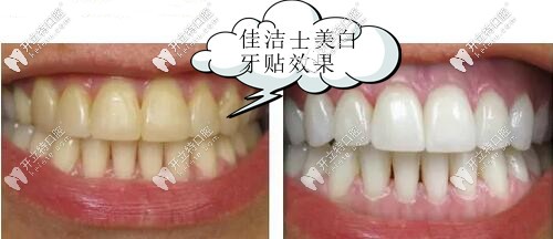 佳潔士美白牙貼效果
