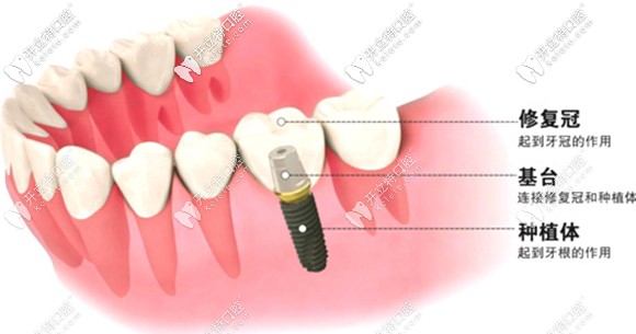 種植牙韓國(guó)和瑞士的差別