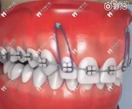 支抗釘解決深覆合