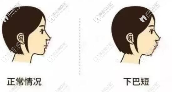 深覆合下巴情況