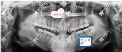 正畸經(jīng)歷了埋伏牙開窗牽引,原來痛苦是自己想出來的