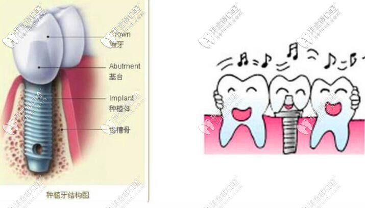 種植牙應(yīng)急措施