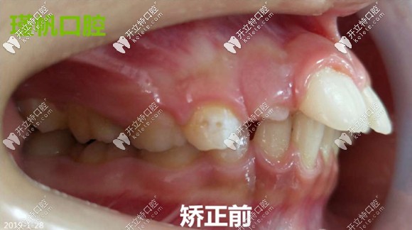 孩子矯正前的牙齒側(cè)位照