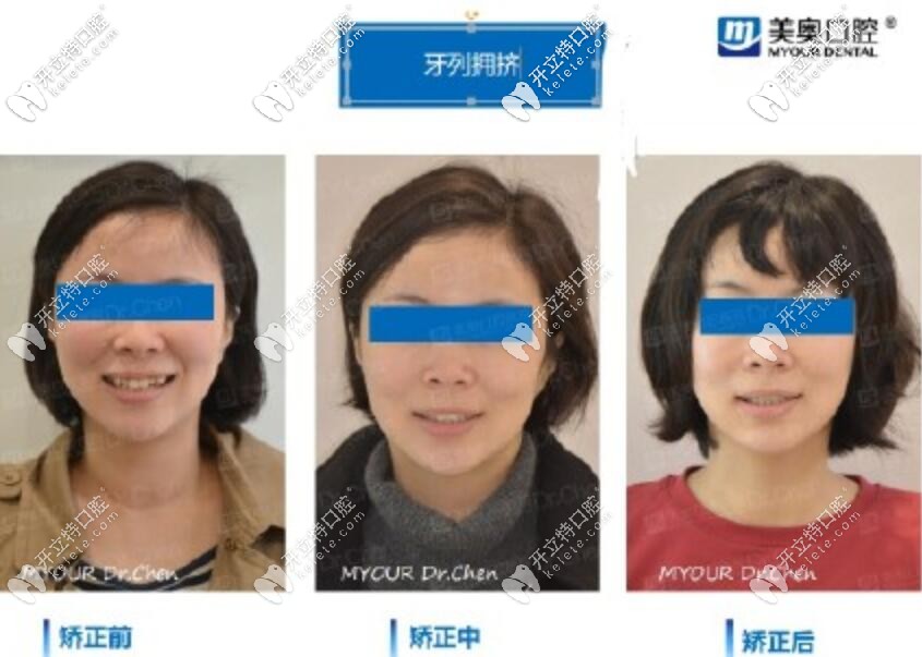 【案例分享】你知道嗎,時(shí)代天使也可以磨牙后推哦