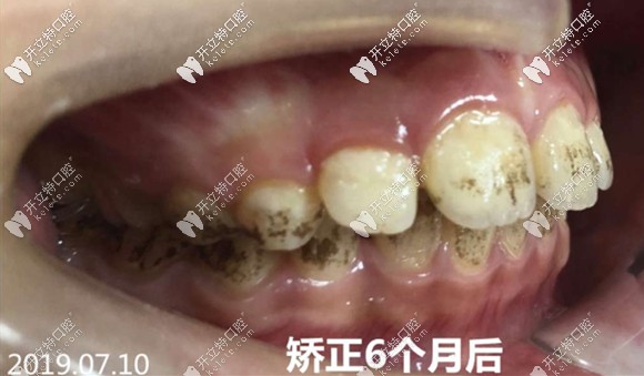 矯治6個月后的牙齒側(cè)貌圖