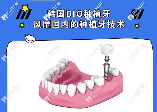 種植牙價(jià)格表