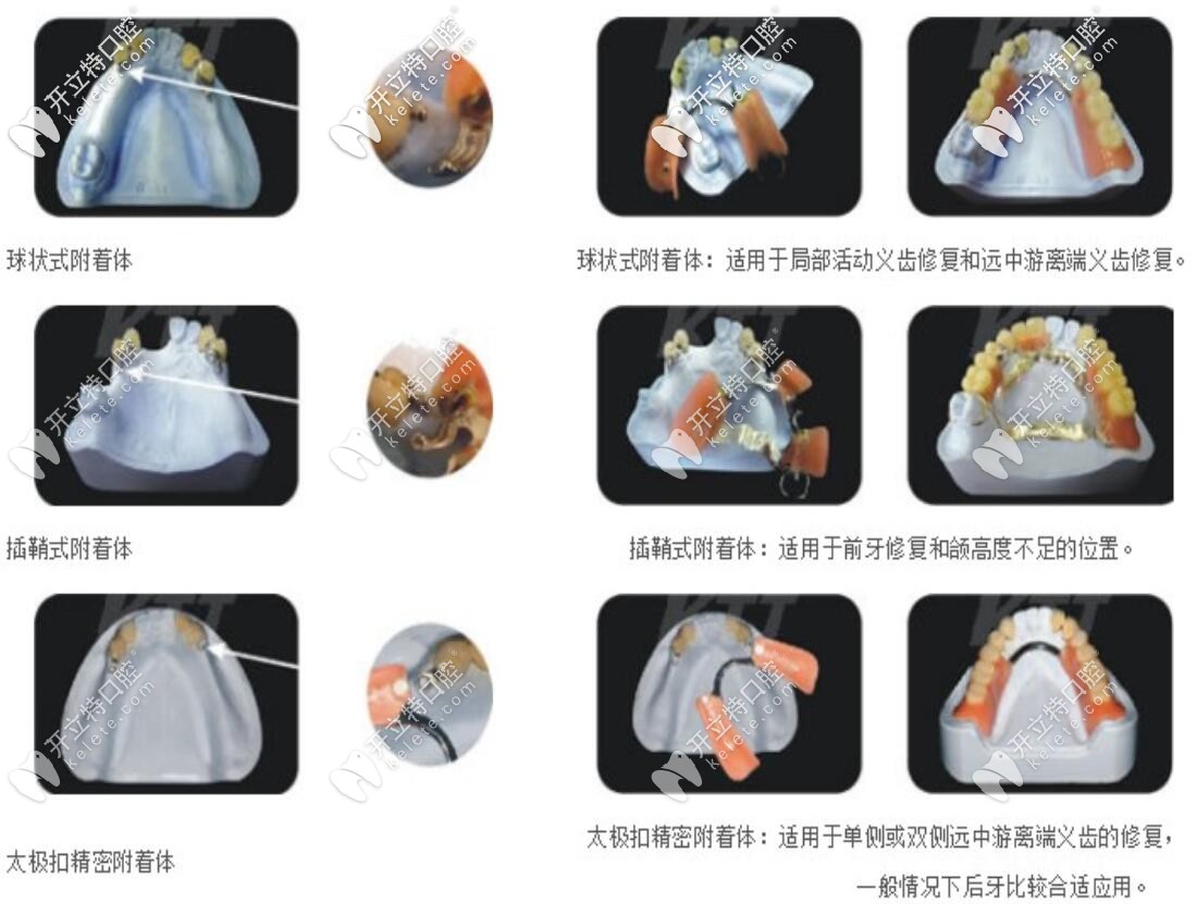 不同精密附著體適應癥