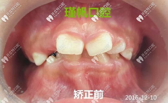 孩子牙列畸形在換牙期做矯正的效果勝過整容,不信進來瞧