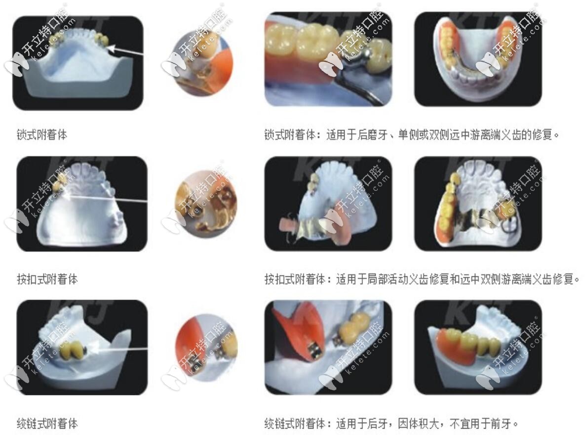 不同精密附著體義齒的適應癥