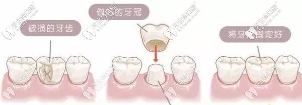 解答：門牙缺了一小塊是選牙齒貼面還是全瓷牙好呢？