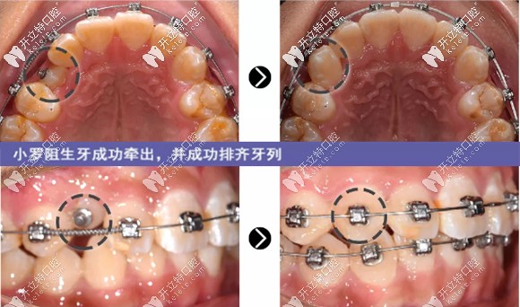 治療8個(gè)月，阻生牙成功牽出并成功排齊牙列