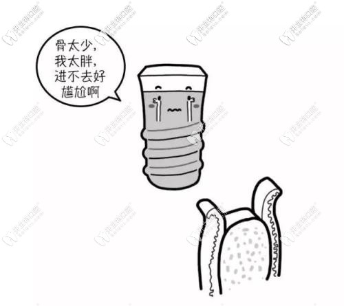 選擇適合牙槽骨的種植體