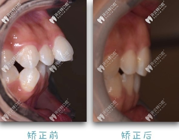 北京勁松齒科金屬自鎖托槽矯正案例