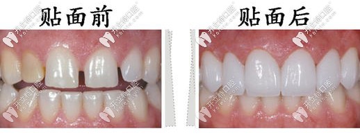 分享我做牙齒貼面5年后感受,附做牙貼面全過程和步驟