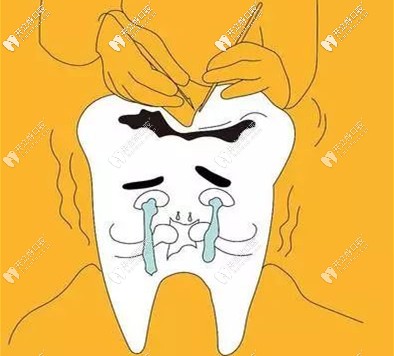 想要做一次性根管治療需要醫(yī)生技術(shù)精細(xì)