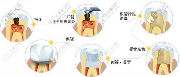 根管治療的步驟