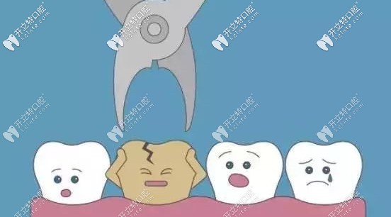 人人都能做一次性根管治療嗎